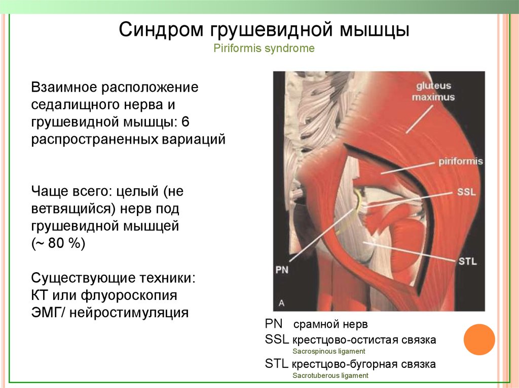 Синдром грушевидной мышцы. Симптом грушевидной мышцы. Синдром грушевидной мышцы симптомы. Грушевидная мышца воспаление.