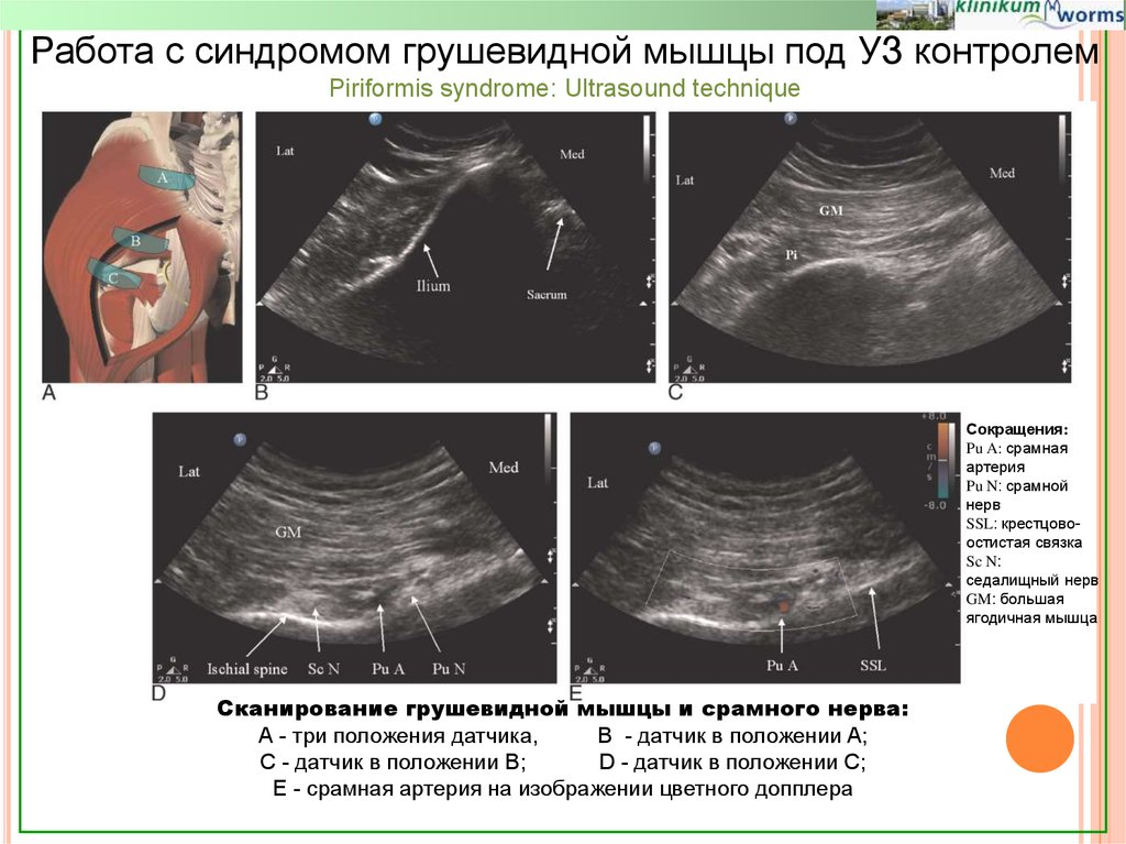 Узи мышц. УЗИ грушевидной мышцы и седалищного нерва. Синдром грушевидной мышцы на УЗИ. Блокада грушевидной мышцы под УЗИ.