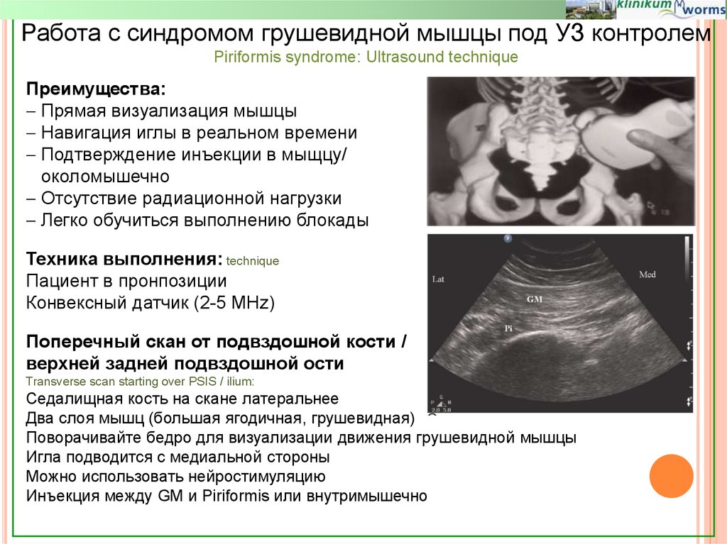 Синдром грушевидной мышцы. Блокада грушевидной мышцы под УЗИ. Блокада грушевидной мышцы. Синдром грушевидной мышцы на УЗИ.