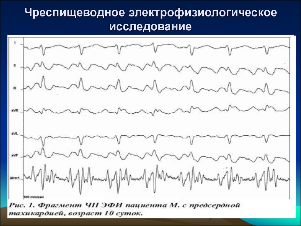 Эфи. Электрофизиологическое исследование (эфи). Чреспищеводная электрофизиологическое исследование сердца. Электрофизиологическое исследование сердца заключение. Чреспищеводная ЭКГ.