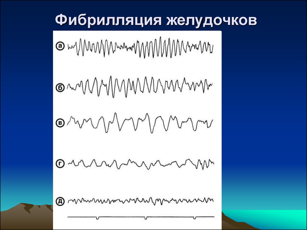 Фибрилляция желудочков на экг фото с заключением