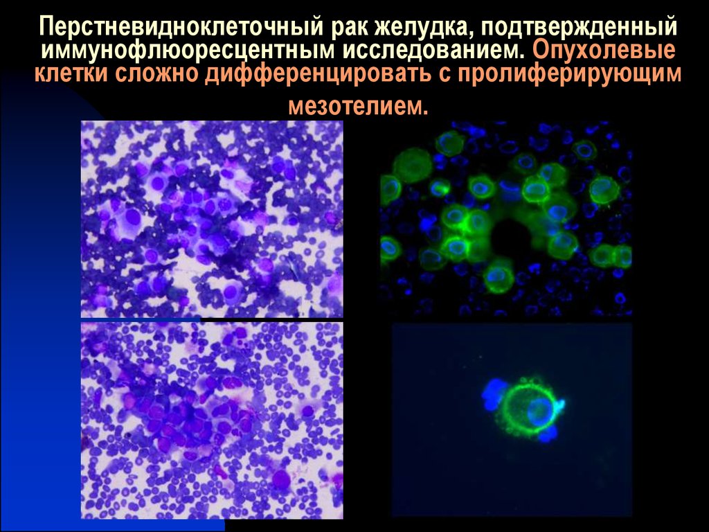 Перстневидно клеточный рак. Перстневидно-клеточныйракжелудк. Пролиферация клеток мезотелия. Дифференцированные опухолевые клетки. Иммунофлюоресцентное окрашивание клеток.