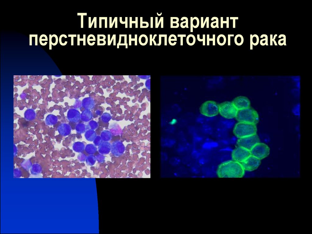 Выпотные жидкости презентация