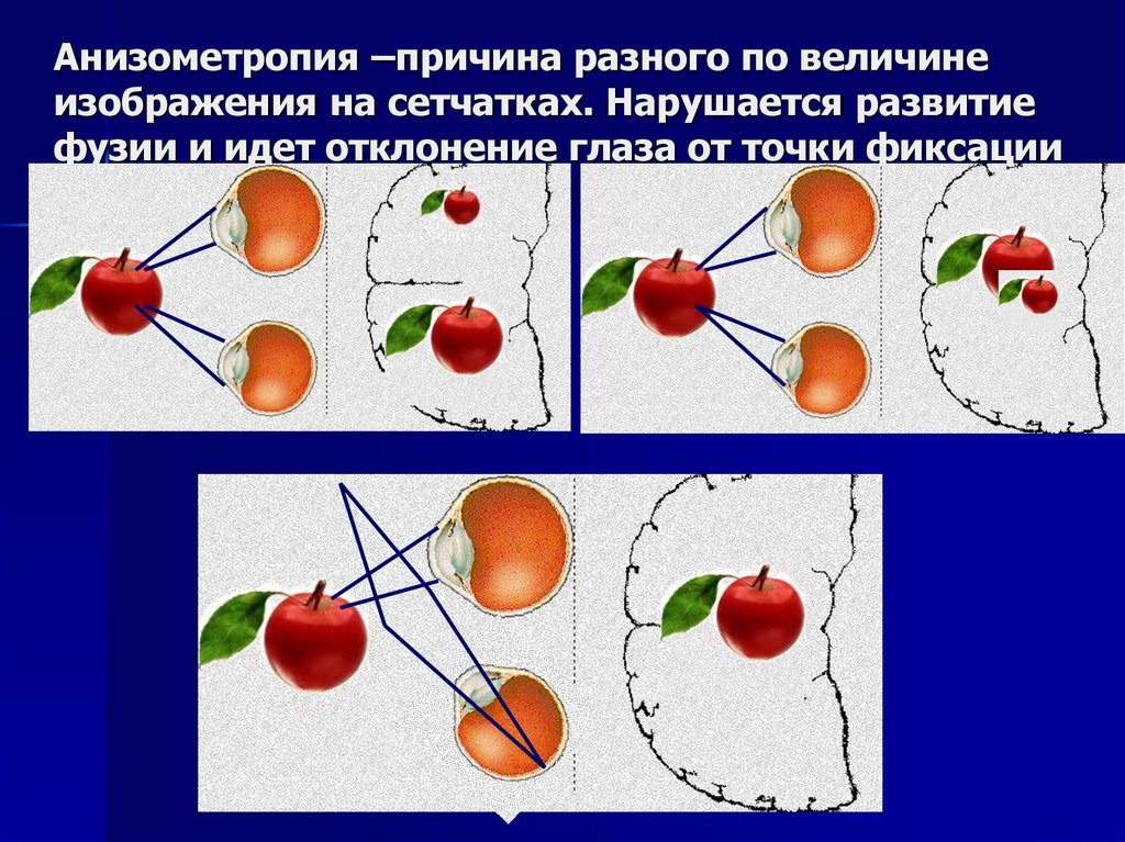 Почему различна. Болезнь глаз анизометропия. Анизометропия высокой степени. Осевая анизометропия. Анизометропия методы коррекции.