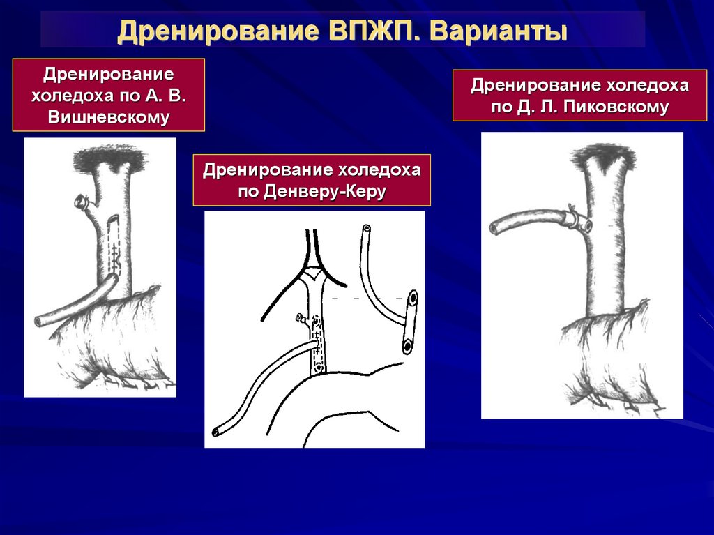 Дренирование. Дренирование по Пиковскому. Пиковскому дренирование холедоха. Дренирование холедоха по Холстеду Пиковскому. Методы дренирования холедоха по Пиковскому.