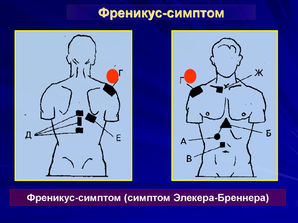 Положительный френикус симптом