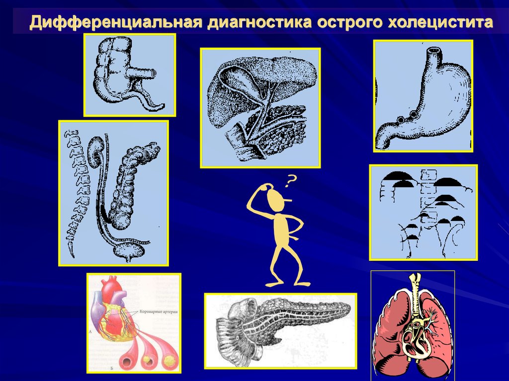 Диагноз острый холецистит. Острый холецистит диагностика. Методы диагностики острого холецистита. Острый холецистит желтуха. Дифференциальная диагностика острого холецистита.