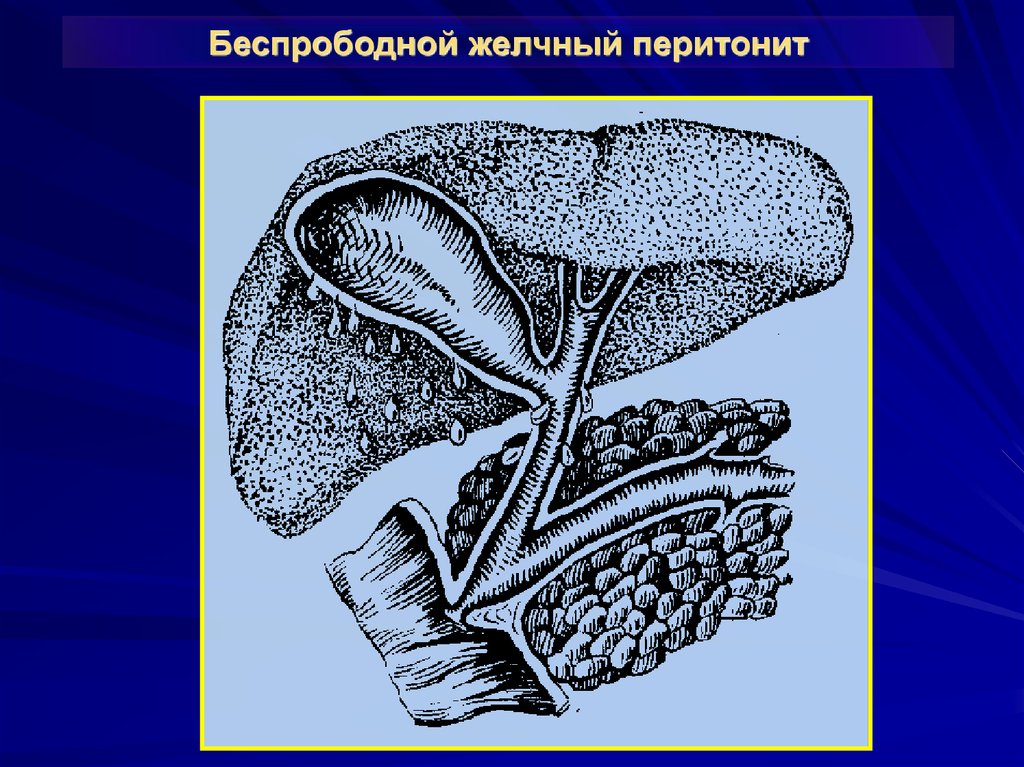 Хирургия механическая желтуха презентация