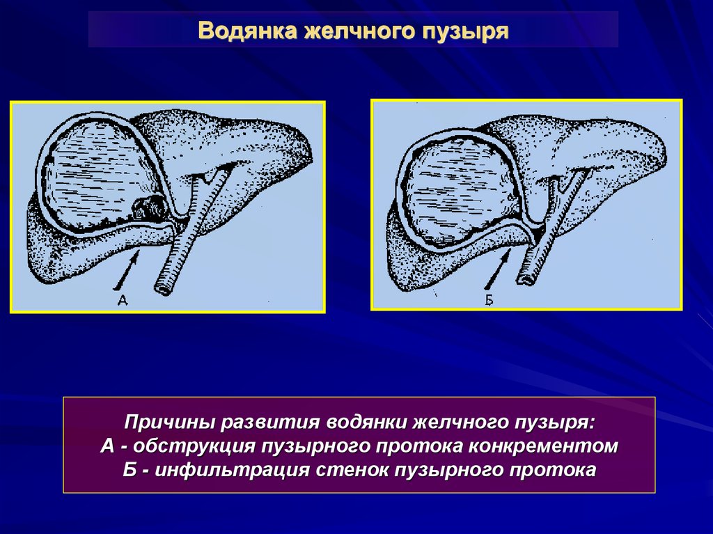 Желчный причины. Водянка и эмпиема желчного пузыря. Эмпиема желчного пузыря этиология. Водянк ажелчноого пузыря. Водянка и эмпиема желчного пузыря хирургия.