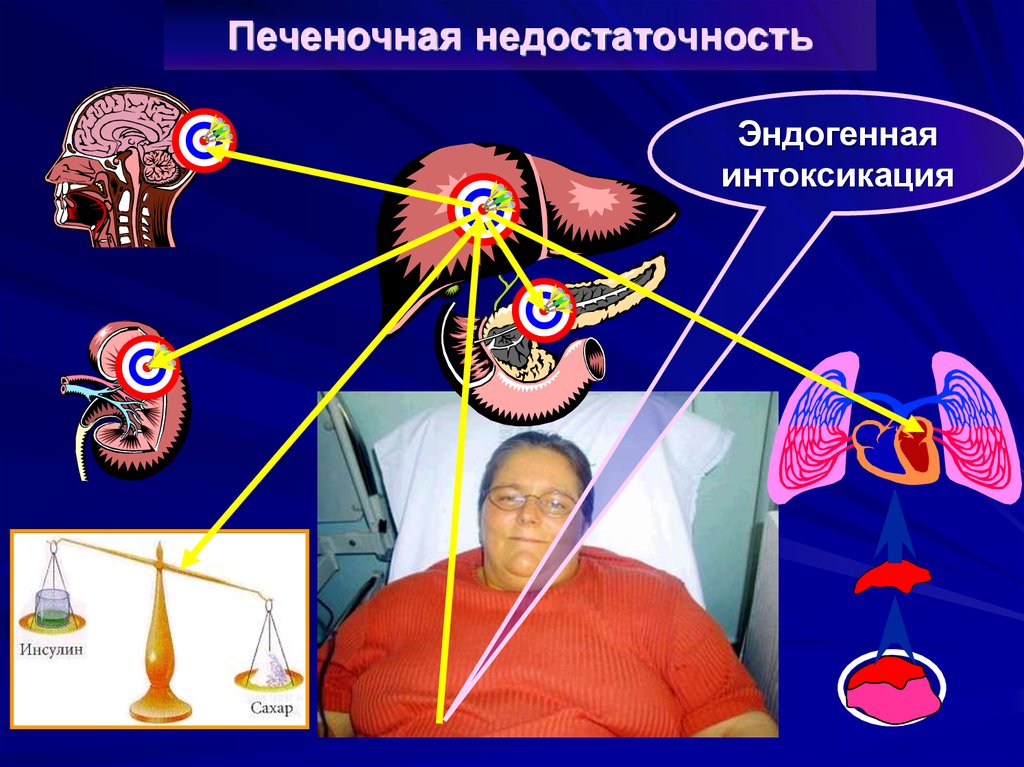 Печеночная недостаточность. Эндогенная печеночная недостаточность. Печеночная недостаточность желтуха. Печеночная недостаточность кожа.