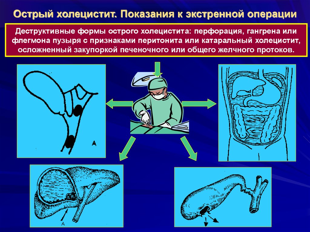 Холецистит карта смп