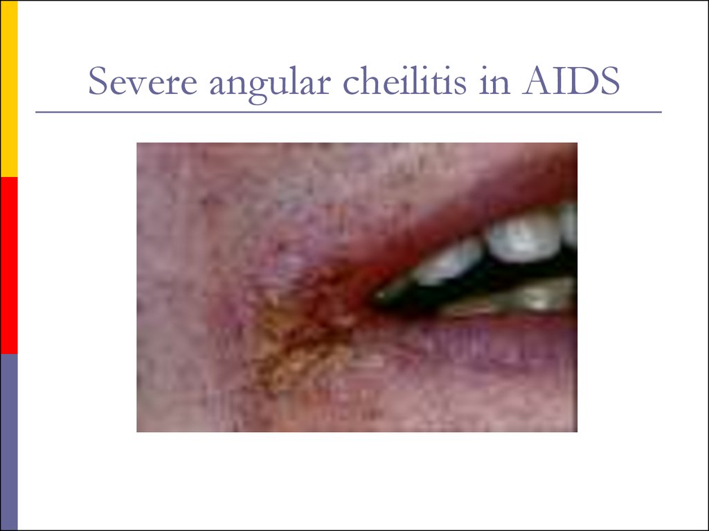 Severe angular cheilitis in AIDS