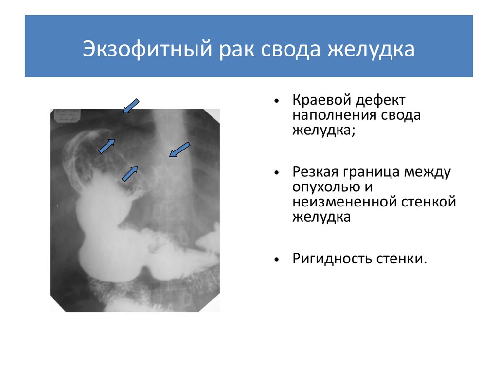 Эндофитный рост опухоли. Экзофитная опухоль желудка рентген. Рентгенологические признаки злокачественной опухоли желудка. Фиброма желудка рентген. Неоплазия желудка на рентгене.