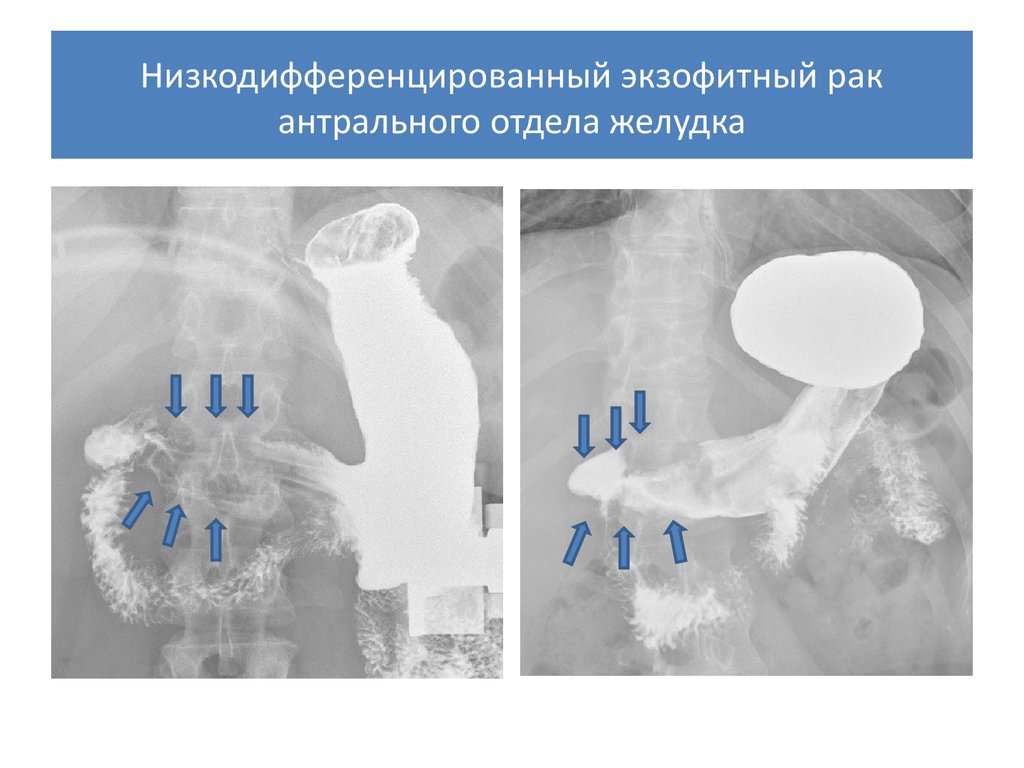 Рак антрального отдела. Низкодифференцированные опухоли ЖКТ. Низкодифференцированная опухоль желудка. Экзофитный рост опухоли желудка.