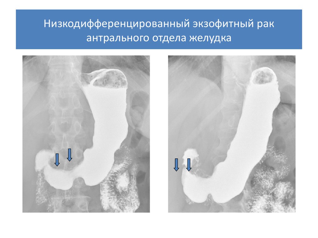 Рак антрального отдела. Опухоль антрального отдела желудка. Экхофитныйрак желудка. Опухоль желудка рентген. Экзофитная опухоль желудка.