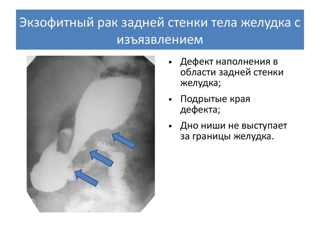 Экзофитный рак. Экзофитная опухоль желудка рентген. Экзофитная форма роста опухоли желудка. Эндофитная опухоль желудка.