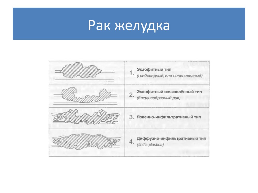 Эндофитный рост опухоли рисунок