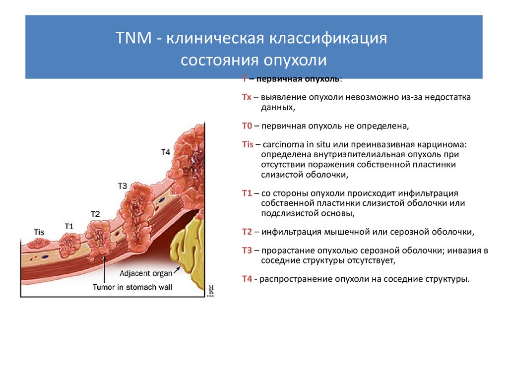 Отсутствие внутриэпителиального поражения. Опухоль желудка классификация TNM. Классификация опухолей TNM. Клиническая классификация опухолей по стадиям. Классификация TNM онкология.