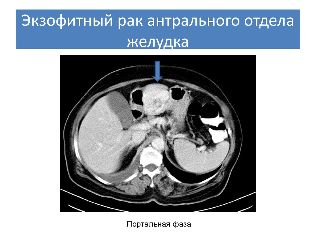 Рак антрального отдела. Экзофитные опухоли желудка кт. Экзофитная опухоль желудка на кт. Опухоль антрального отдела на кт.