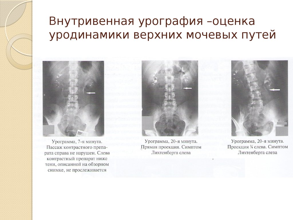 Экскреторная урография презентация