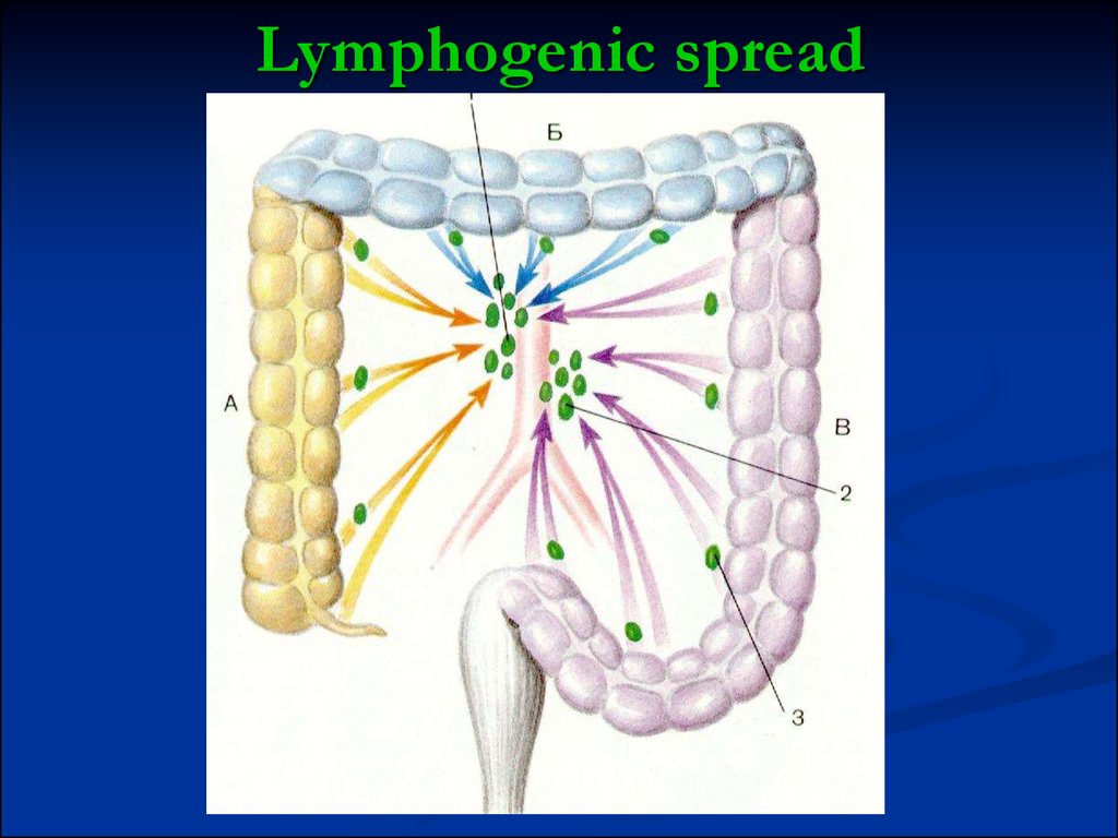 Lymphogenic spread