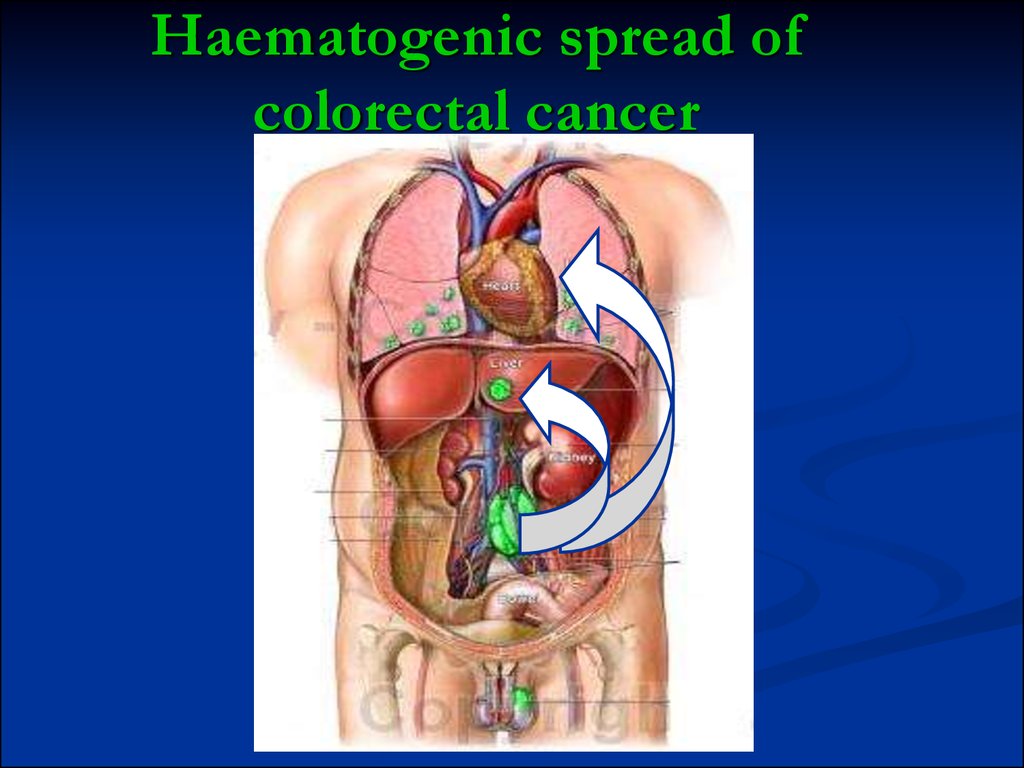 Haematogenic spread of colorectal cancer
