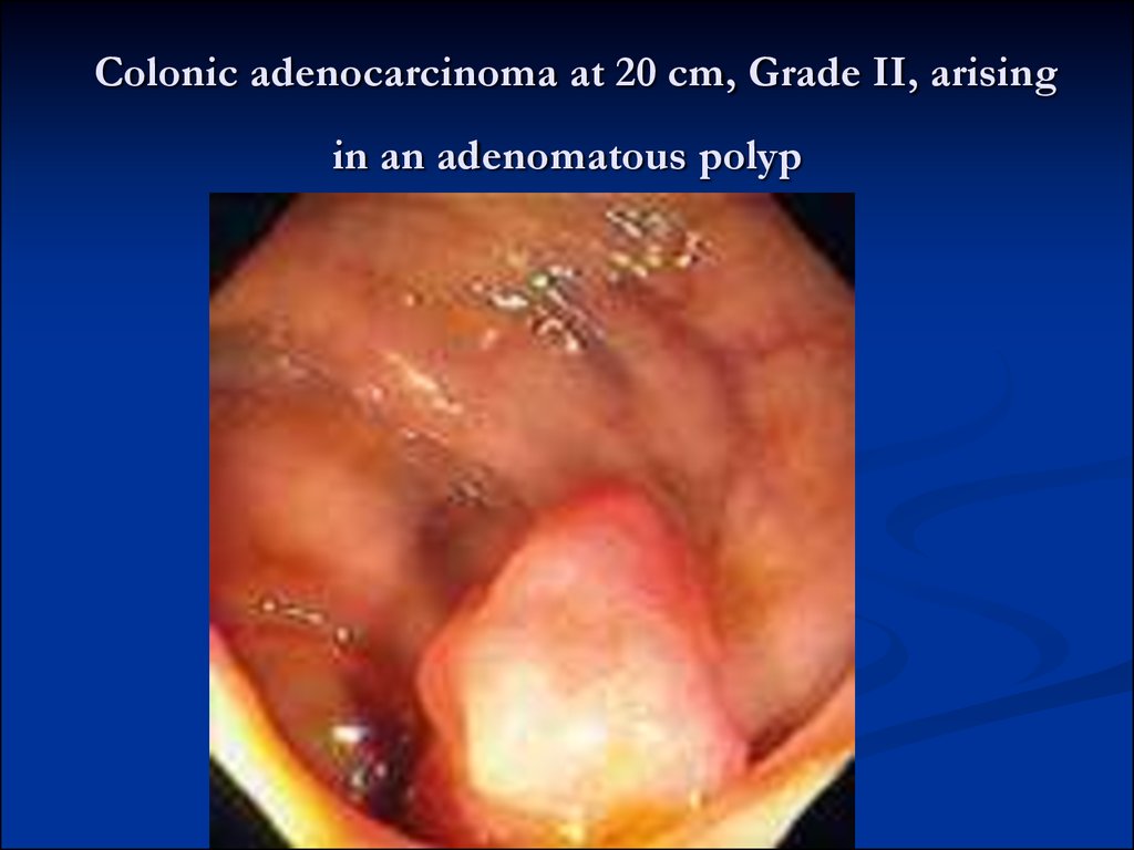 Colonic adenocarcinoma at 20 cm, Grade II, arising in an adenomatous polyp