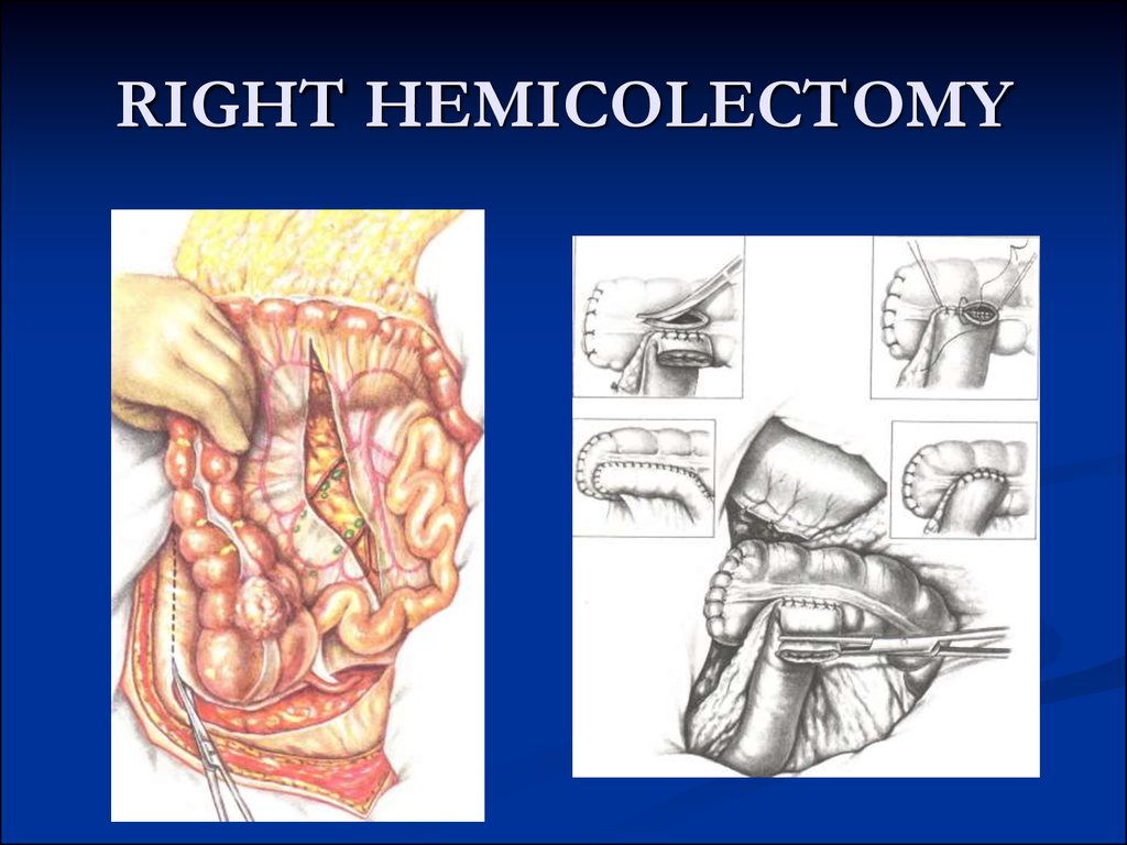 Colorectal Cancer презентация онлайн 4066