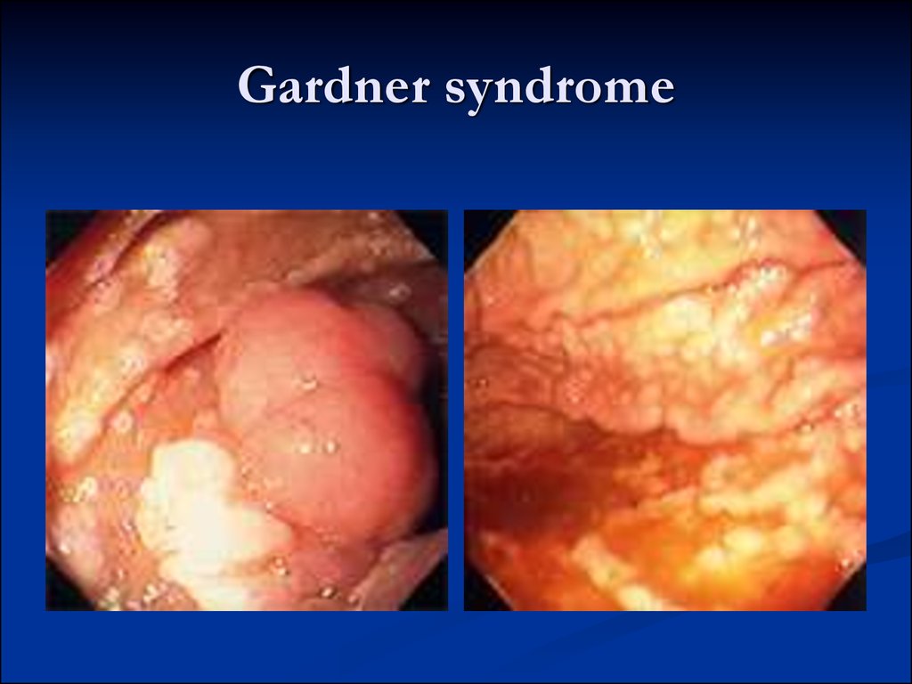 Gardner syndrome