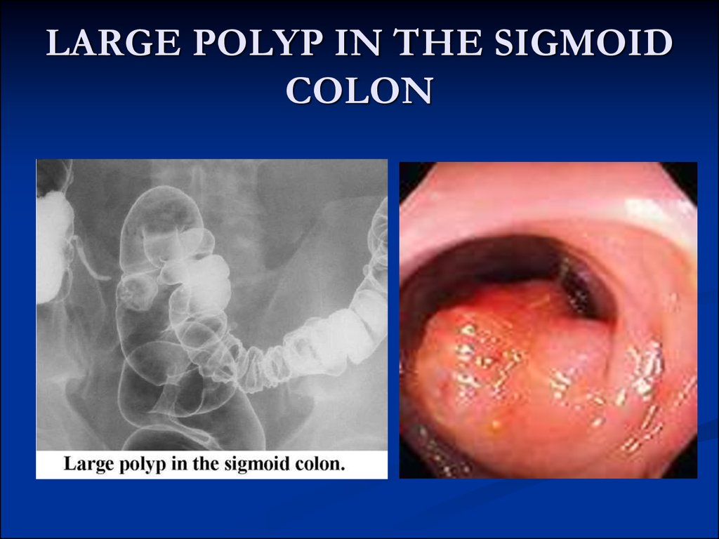 LARGE POLYP IN THE SIGMOID COLON