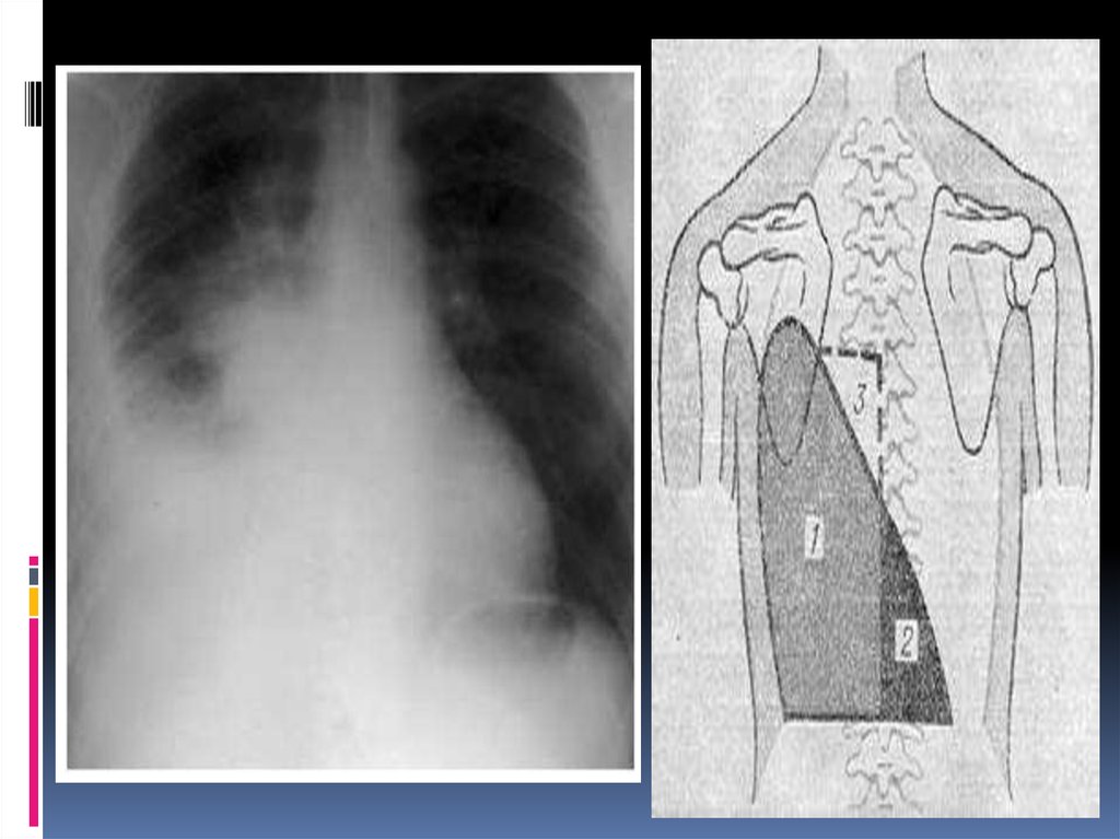 Плевральная спайка слева. Сухой плеврит рентген. Плевральная шварта рентген. Плевродиафрагмальные спайки рентген.