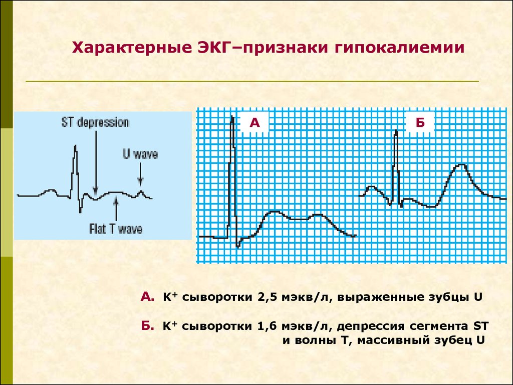 Гиперкалиемия экг картина