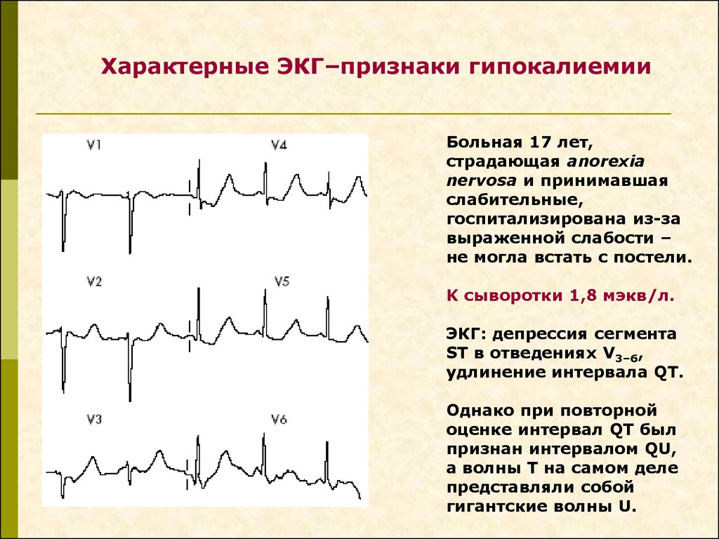 Гипокалиемия на экг картинки