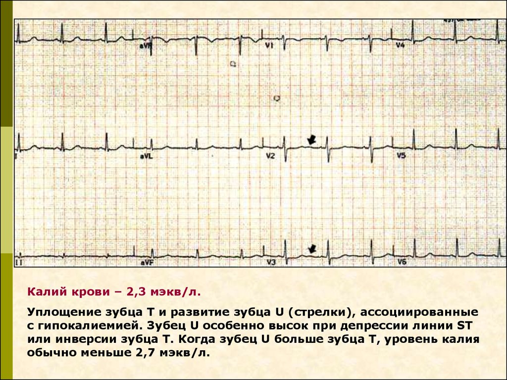 Гипокалиемия на экг картинки