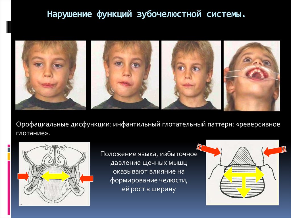 Инфантильное глотание это