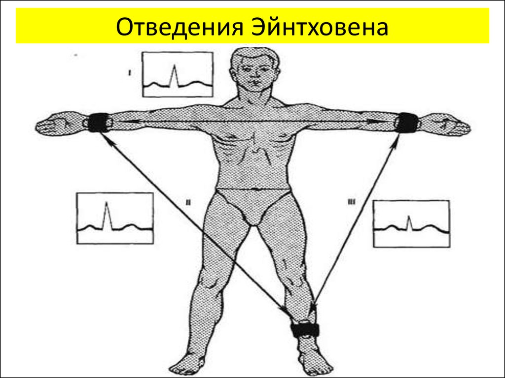 Левые отведения. Теория отведений Эйнтховена. Треугольник отведений Эйнтховена. Теория отведений Эйнтховена, три стандартных отведения.. Треугольник Эйнтховена стандартные отведения.