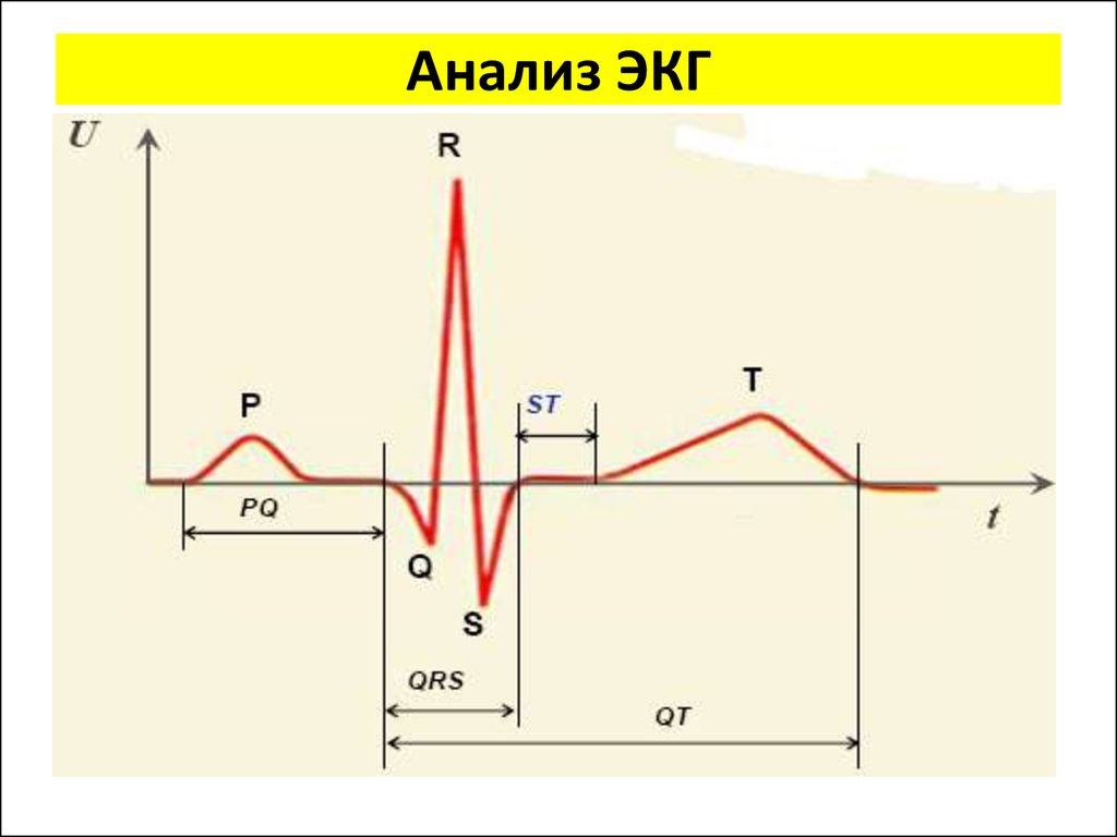 П нормальная. Нормальная электрокардиограмма схема. Анализ QRS ЭКГ. Схема нормальной ЭКГ. Анализ комплекса QRS на ЭКГ.