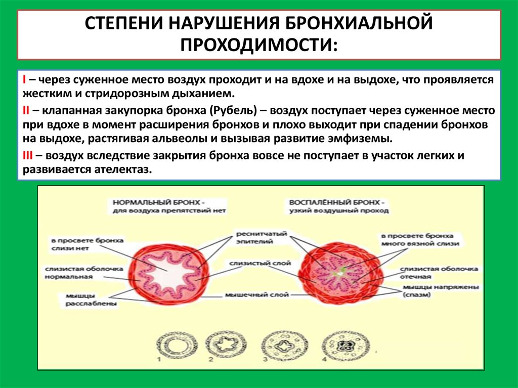 Нарушение проходимости. Лёгкие нарушения бронхиальной проводимости. Нарушение бронхиальной проходимости первой степени.. При синдроме нарушения бронхиальной проводимости. Стадии нарушения бронхиальной проходимости.