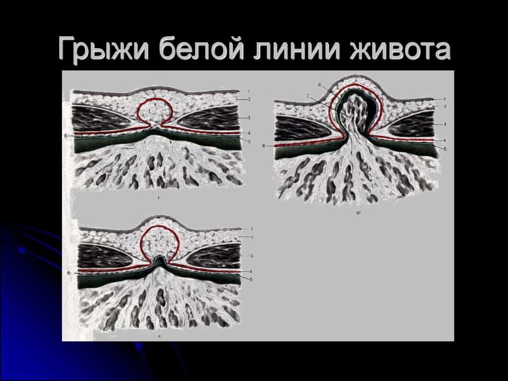 На какой день выписывают после удаления грыжи белой линии живота