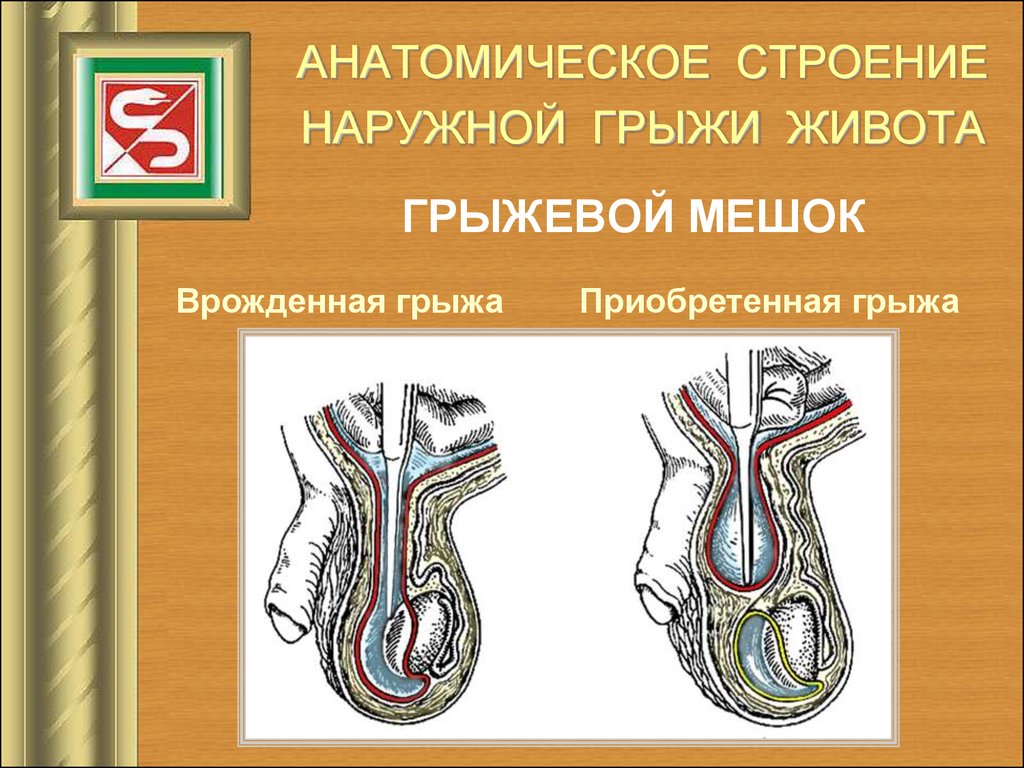 Грыжа брюшной стенки. Наружные грыжи живота строение. Грыжевой мешок строение. Грыжа живота классификация.