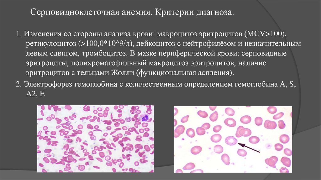 Анемия в моче. Серповидноклеточная анемия гистология. Серповидноклеточная анемия картина крови. Кровь при серповидноклеточной анемии. Серповидноклеточная анемия анализ крови.