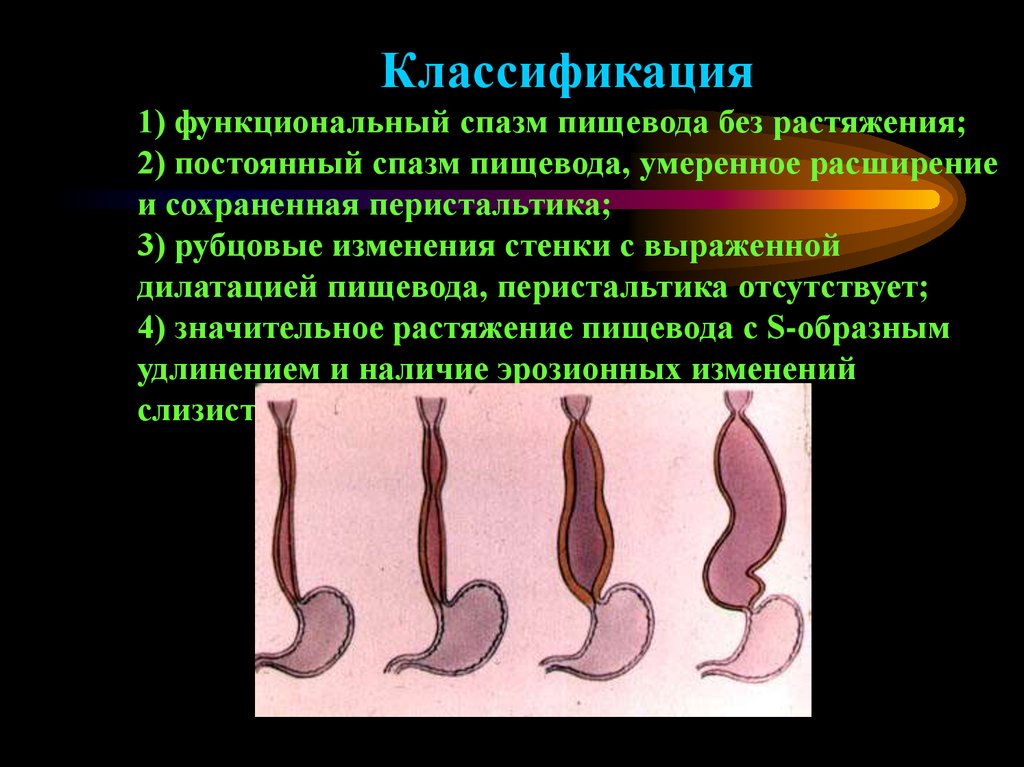 Заболевания пищевода хирургия презентация