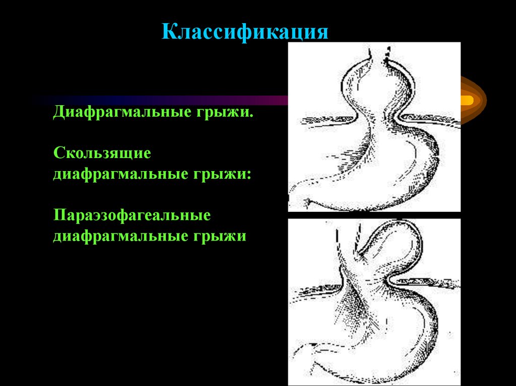 Грыжа диафрагмы. Врожденные диафрагмальные грыжи классификация. Грыжи диафрагмы классификация. Скользящие и параэзофагеальные грыжи. Методы исследования диафрагмальной грыжи.