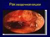 Рак ободочной кишки