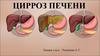 Цирроз печени