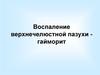 Воспаление верхнечелюстной пазухи гайморит