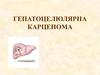 Гепатоцелюлярна карценома