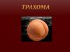 Трахома. Проявление трахомы