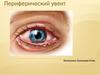 Периферический увеит