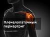 Плечелопаточный периартрит